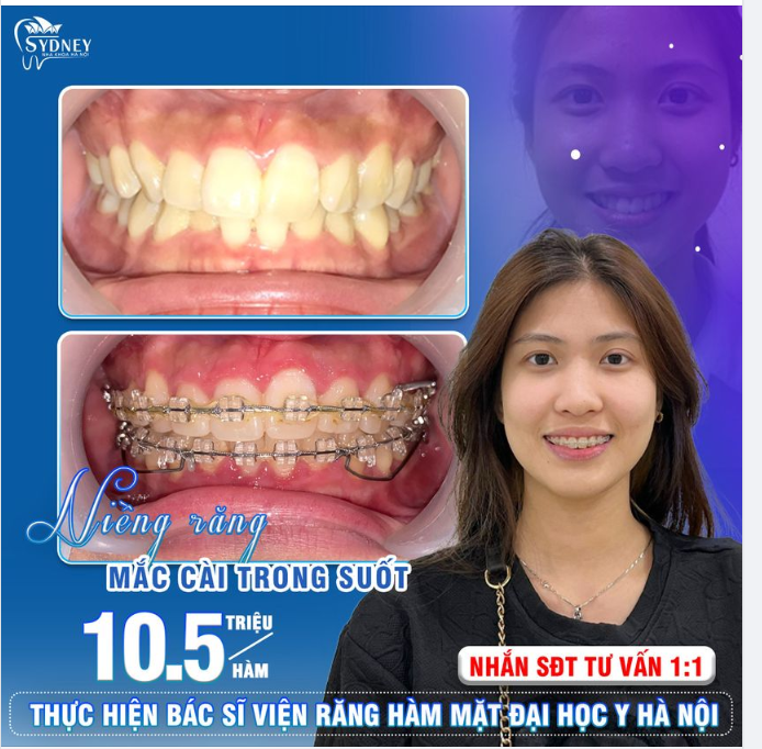 RẠNG NGỜI NỤ CƯỜI VỚI MẮC CÀI TRONG SUỐT