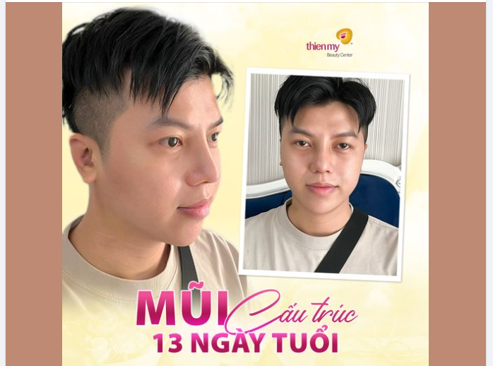 Sau 13 ngày nâng mũi cấu trúc, KH đã quay trở lại Thiện Mỹ để thực hiện cắt chỉ.
