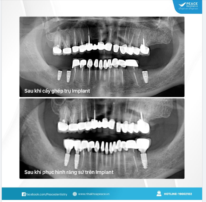 CẤY GHÉP IMPLANT LÀ GIẢI PHÁP TRỒNG RĂNG GIẢ CỐ ĐỊNH ĐEM LẠI HIỆU QUẢ TOÀN DIỆN VỀ THẨM MỸ LẪN CHỨC NĂNG ĂN NHAI