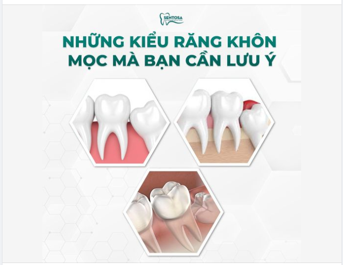 NHỮNG KIỂU RĂNG KHÔN MỌC MÀ BẠN CẦN LƯU Ý