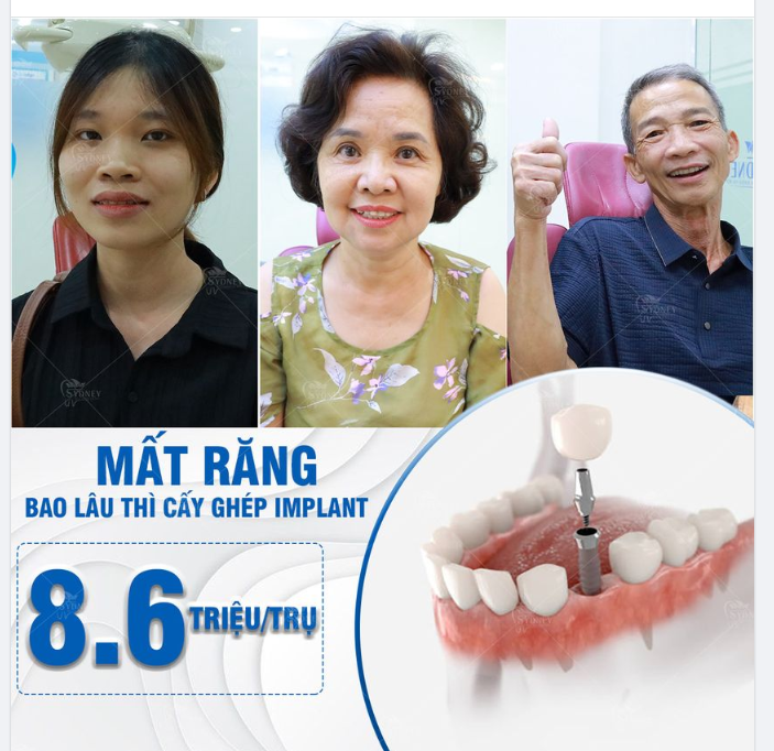 SAU KHI NHỔ RĂNG BAO LÂU THÌ TRỒNG IMPLANT?