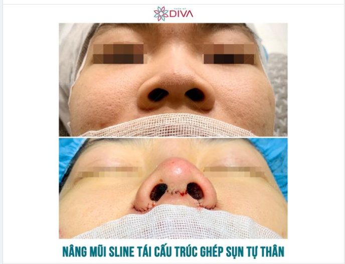 AI CŨNG CÓ THỂ NÂNG MŨI GHÉP SỤN TỰ THÂN ĐÚNG KHÔNG?