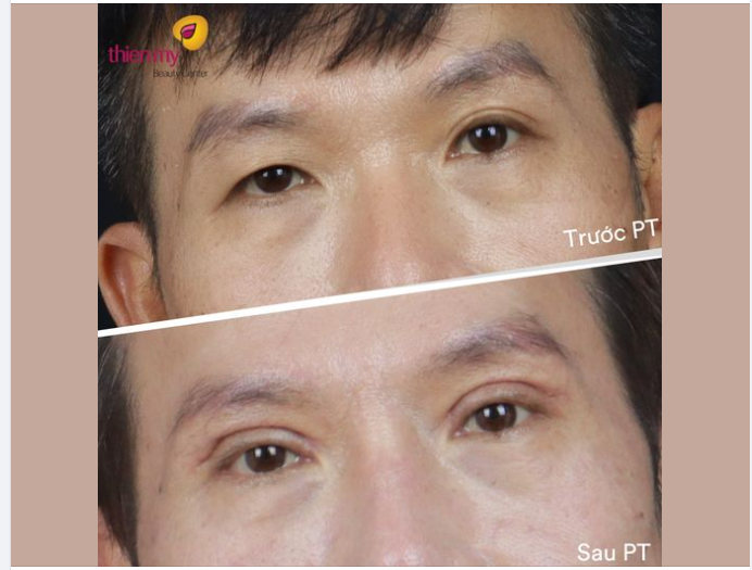 SỤP MÍ BẨM SINH CHỈ LÀ CHUYỆN NHỎ!