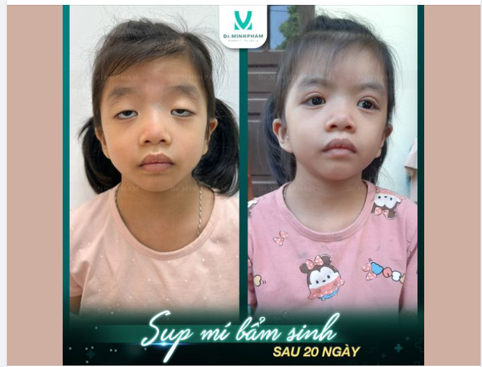 BÁC SĨ KIỂM TRA MẮT CHO TRẺ NHỎ BỊ SỤP MÍ BẨM SINH