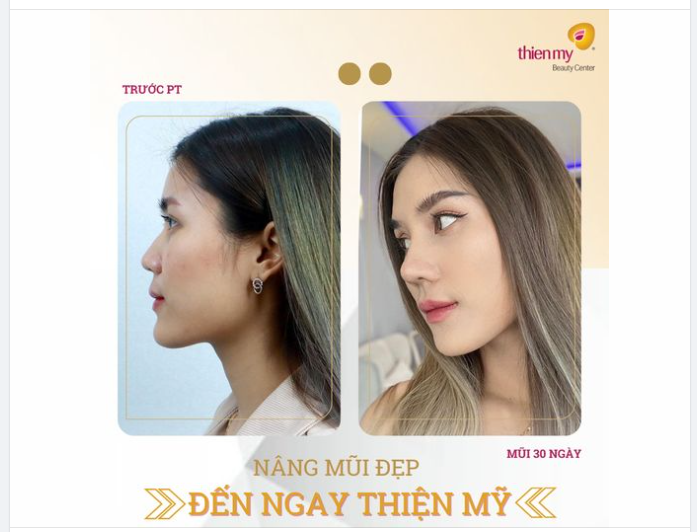 30 NGÀY- SAU KHI NÂNG MŨI CẤU TRÚC TẠI THIỆN MỸ