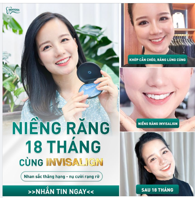 NỤ CƯỜI RẠNG RỠ SAU 18 THÁNG CÙNG INVISALIGN