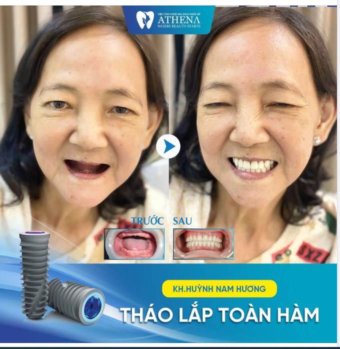 KẾT QUẢ HÀM THÁO LẮP TOÀN HÀM CỦA KHÁCH HÀNG HUỲNH NAM THƯƠNG TẠI NHA KHOA ATHENA