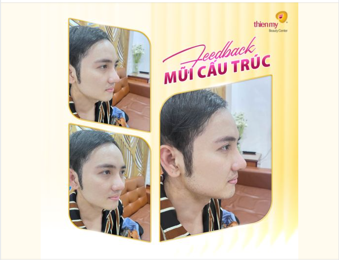 CẬN CẢNH KẾT QUẢ KHÁCH HÀNG TÁI KHÁM SAU 10 NGÀY NÂNG MŨI