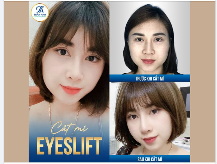 GIẢI CỨU MÍ LỆCH - MÍ KHÔNG ĐỀU