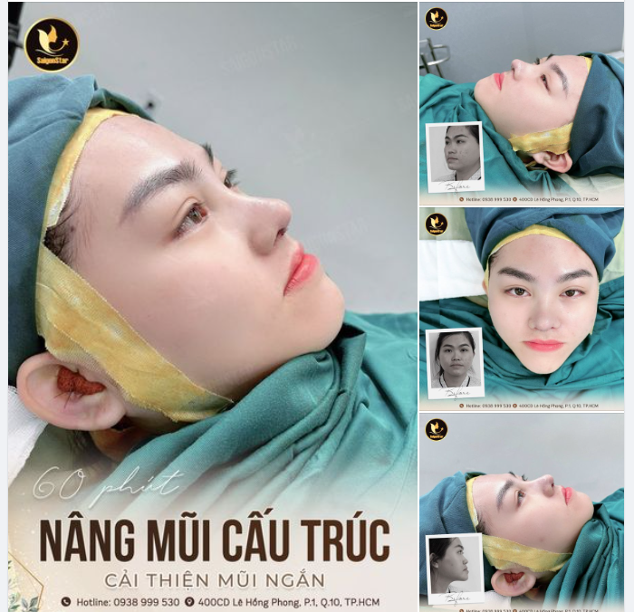 Đỉnh của chóp Dáng mũi sau 60 phút được “nặn” bởi Bác sĩ Hoạt