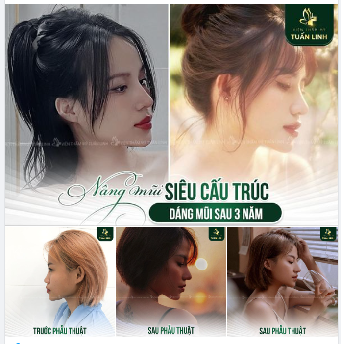  Kỹ thuật nâng mũi đảm bảo an toàn, bền chắc cùng bàn tay khéo léo của bác sĩ sẽ giúp bạn sở hữu được dáng mũi bền đẹp dài lâu.