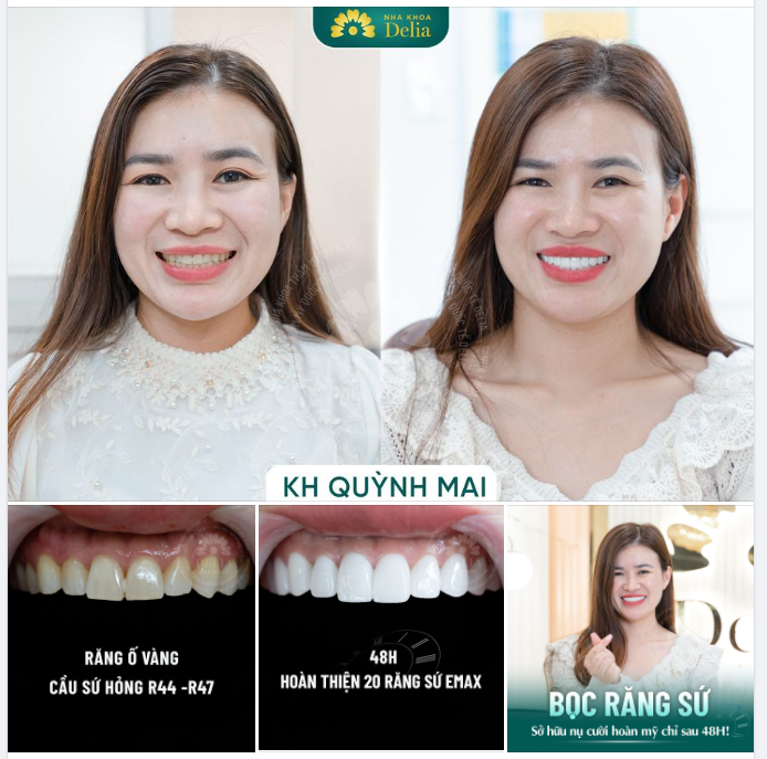 Bọc răng sứ kiến tạo nụ cười khoẻ đẹp chỉ sau 48H