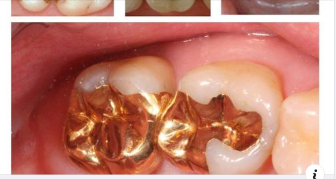 Chọn chất liệu trám phù hợp cho răng của bạn như thế nào