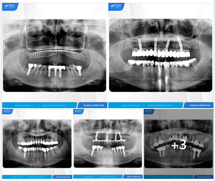 ĐÃ ĐẾN LÚC TÌM LẠI NỤ CƯỜI TRỌN VẸN VỚI SỰ TRỢ GIÚP CỦA CẤY GHÉP NHA KHOA!