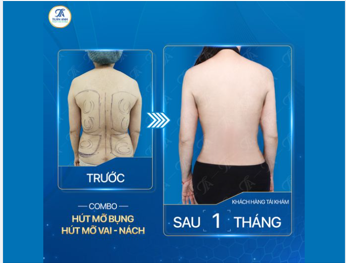 LẤY LẠI VÓC DÁNG MẢNH MAI NHƯ THỜI CON GÁI
