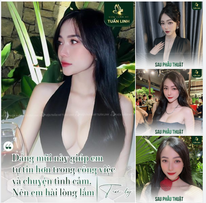 T.L Hạnh phúc với hiện tại sau 2 năm nâng mũi cấu trúc!!