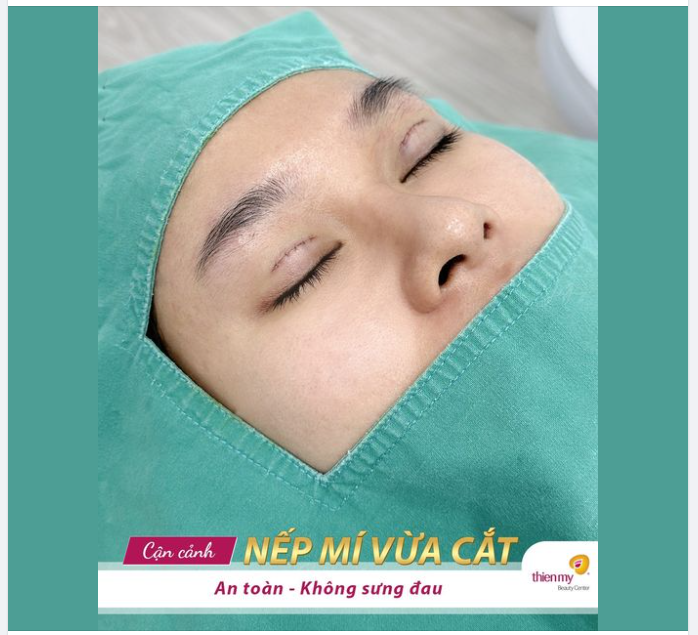 Cắt mí không sưng, không đau là có thật chị em ạ!