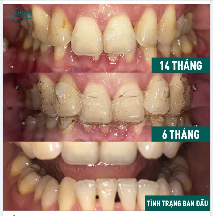 Chị Hằng bắt đầu tìm hiểu và biết đến Invisalign, tham khảo ở nhiều Nha khoa khác nhau, cuối cùng chị lựa chọn Sentosa để gửi gắm nụ cười.
