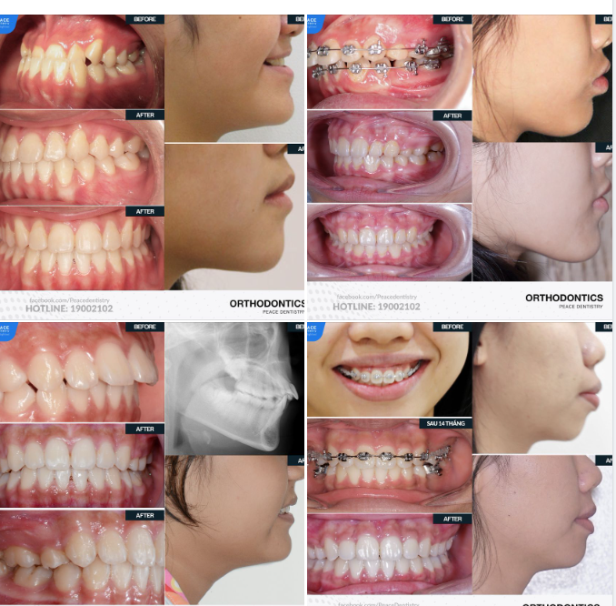 NIỀNG RĂNG CÓ THẬT SỰ KHIẾN BẠN GIẢM CÂN KHÔNG?