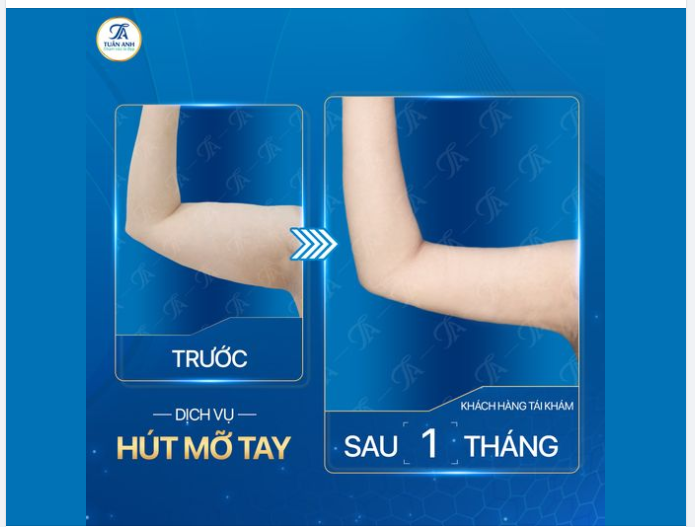 KẾT QUẢ SAU 1 THÁNG HÚT MỠ THON GỌN CÁNH TAY