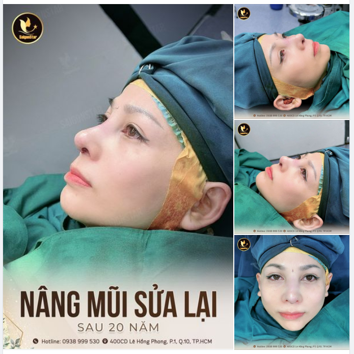 NÂNG MŨI SỬA LẠI SAU 20 NĂM ĐẸP TỰ NHIÊN NHƯ NÂNG LẦN ĐẦU