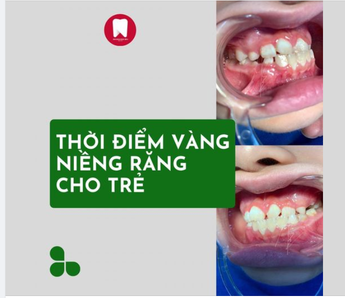 Niềng răng hôm nay cho trẻ. Vì một tương lai răng miệng chắc khoẻ . Ba mẹ có biết:
