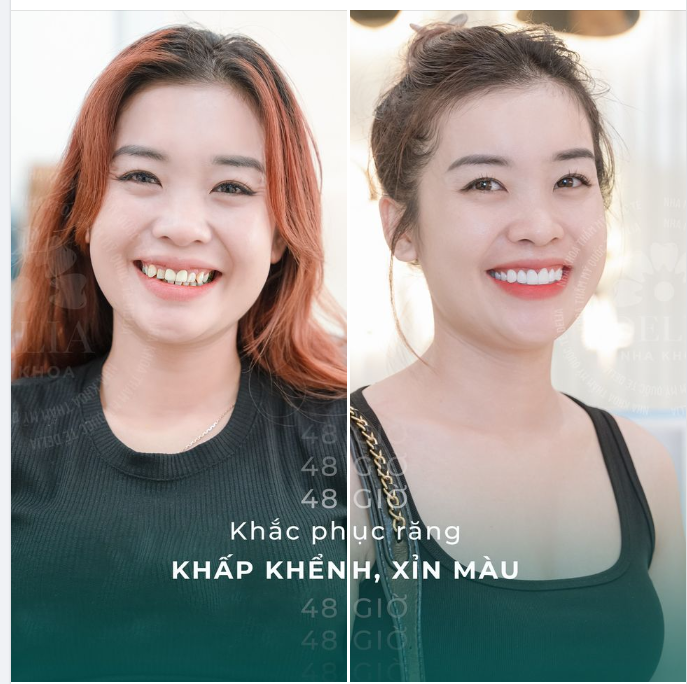 Răng khấp khểnh, xỉn màu khắc phục như thế nào?