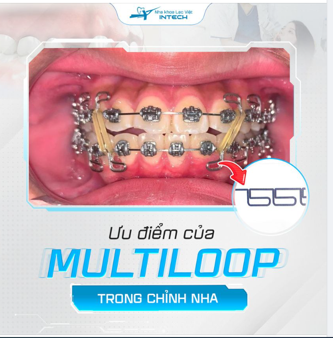 Sức mạnh của Multiloop và kỹ thuật chỉnh nha không phẫu thuật!