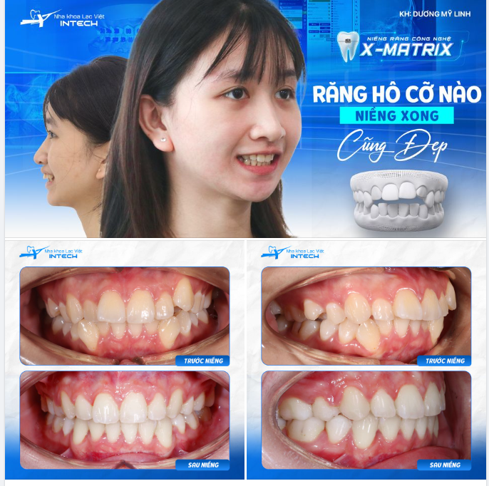 Thanh xuân đẹp hơn kể từ khi bắt đầu niềng răng!