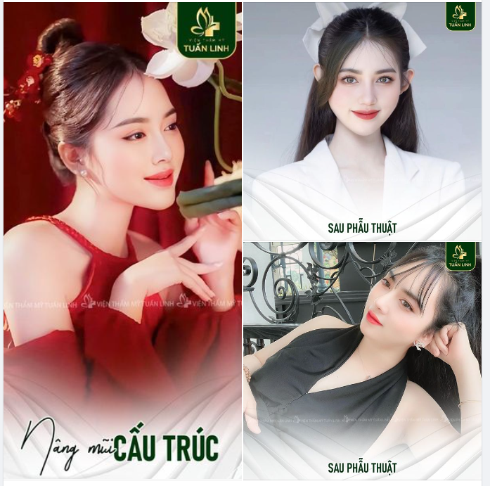Review “sương sương” dáng mũi 1 năm nâng tại Tuấn Linh!!