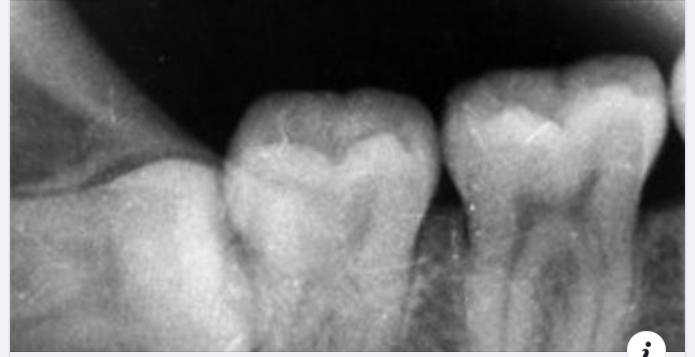 Những lưu ý khi chụp x quang răng khôn
