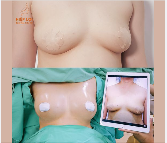Tại sao lại có tình trạng ngực bên to bên nhỏ