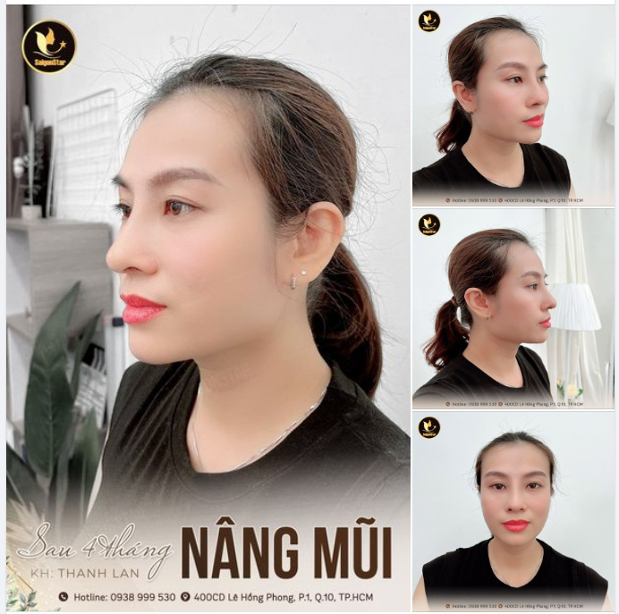 MỪNG NGÀY PHỤ NỮ VIỆT NAM NÂNG MŨI TẠI DR. HOẠT