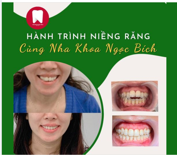 NIỀNG RĂNG ĐI, VÌ BẠN SẼ KHÔNG BAO GIỜ HỐI HẬN ĐÂU!