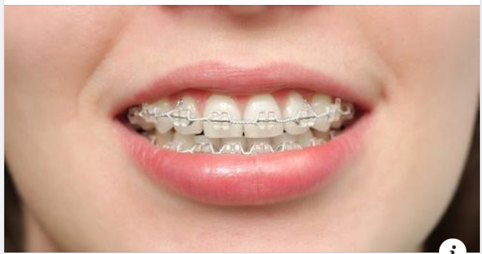 Tại sao mùa hè là thời điểm lý tưởng để CHỈNH NHA?