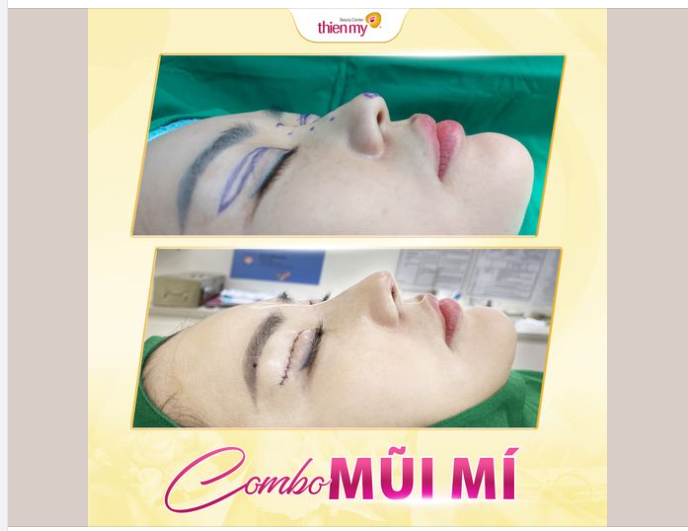 Case combo mũi + Mí được bác sĩ Thiện Thực hiện hôm nay