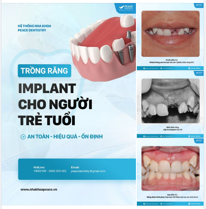 MẤT RĂNG Ở NGƯỜI TRẺ TUỔI