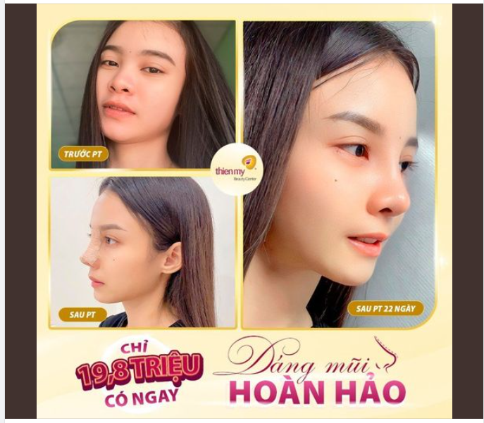 NÂNG MŨI CẤU TRÚC SAU 22 NGÀY