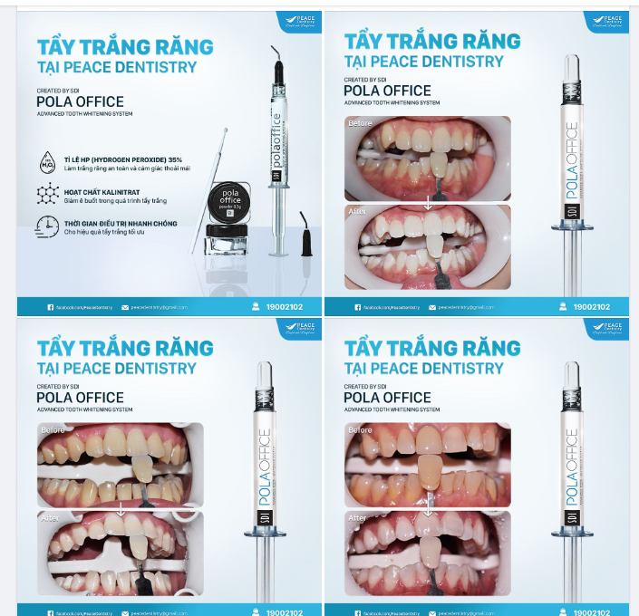 BẠN ĐANG LO LẮNG VỀ TÌNH TRẠNG Ê BUỐT RĂNG KHI TẨY TRẮNG TẠI NHA KHOA?