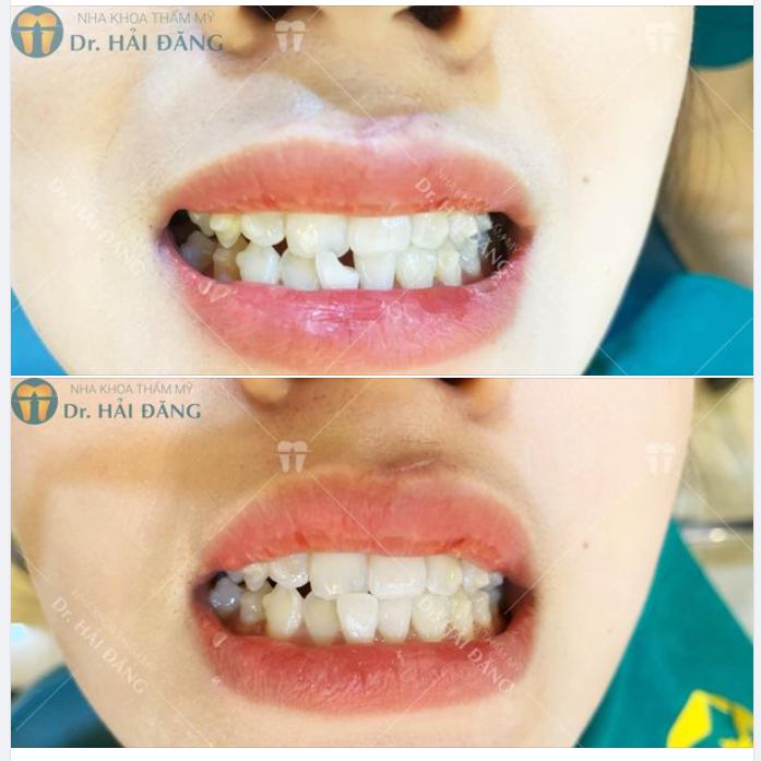 Sự thay đổi kì diệu trước và sau khi chữa răng bị mẻ