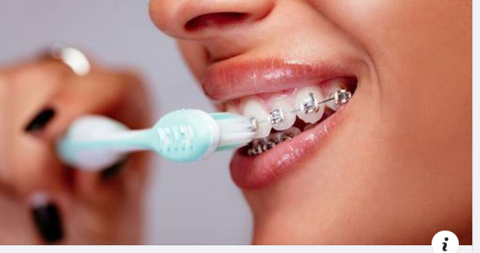 Tầm quan trọng của việc vệ sinh răng miệng khi niềng răng
