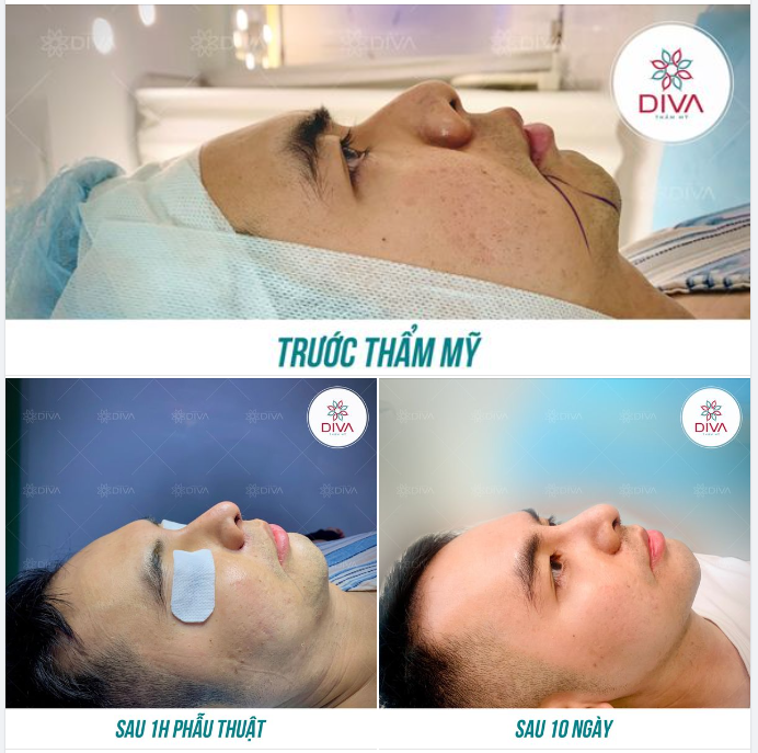 KẾT QUẢ NÂNG MŨI TÁI CẤU TRÚC GHÉP SỤN TỰ THÂN + CẮT CÁNH MŨI SAU 10 NGÀY