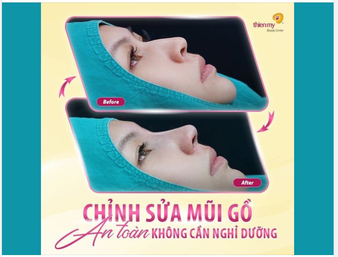 Mũi đẹp up ngay cho "nóng". Khoe nhẹ với cả nhà, ca mài gồ xương mũi hôm nay!!