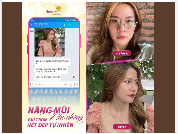 NÂNG MŨI NHẸ NHÀNG, GIỮ TRỌN NÉT ĐẸP TỰ NHIÊN