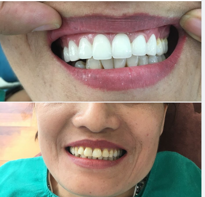 Răng sứ kim loại có mấy loại