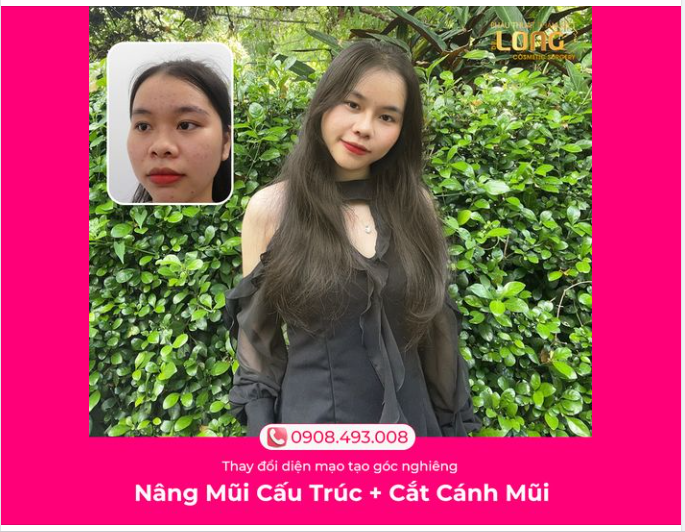 MẶT THON GỌN MŨI THANH CAO KẾT QUẢ NGAY SAU 1 THÁNG LÀM ĐẸP