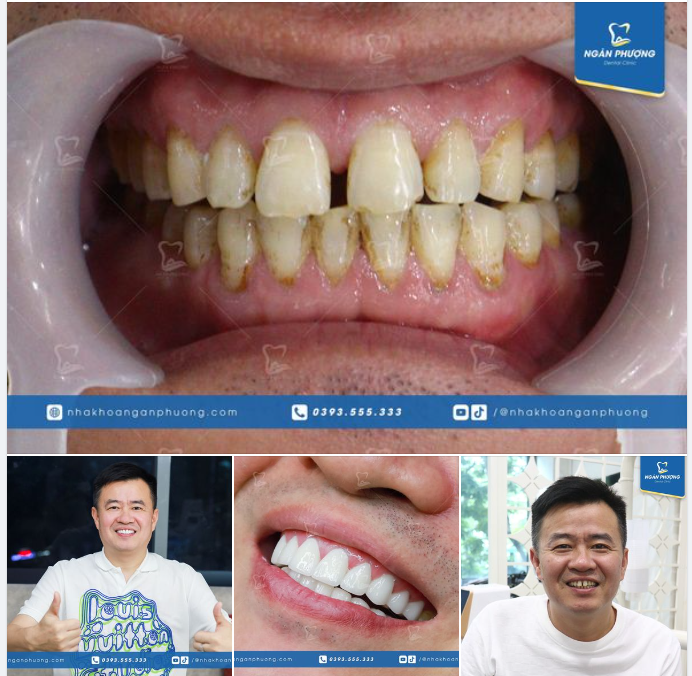 "Không nghĩ làm răng sứ xong có thể nam tính như thế này." - Anh Yi Xiang Jiang, người Trung Quốc cảm thán khi lần đầu soi gương sau khi lắp răng sứ.