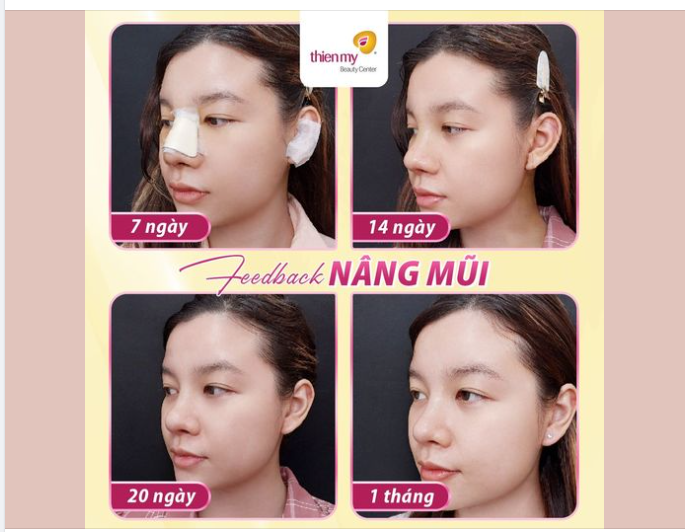 SỞ HỮU CHIẾC MŨI ĐẸP KHÔNG KHÓ!!!