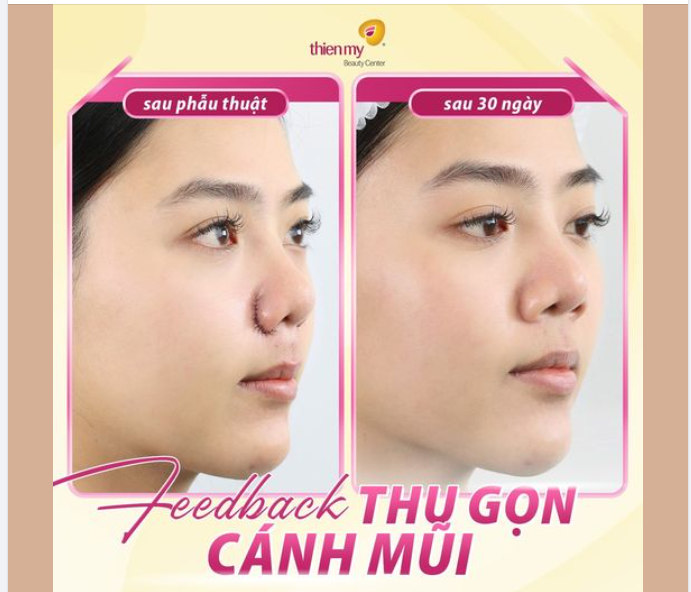 THU GỌN CÁNH MŨI – NÂNG TẦM NHAN SẮC