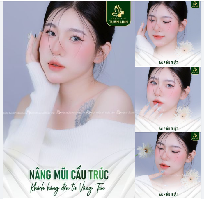 Cô nàng 2k3 đến từ Vũng Tàu khoe chiếc mũi siêu xinh sau 3 tháng nâng cấu trúc tại Tuấn Linh!!